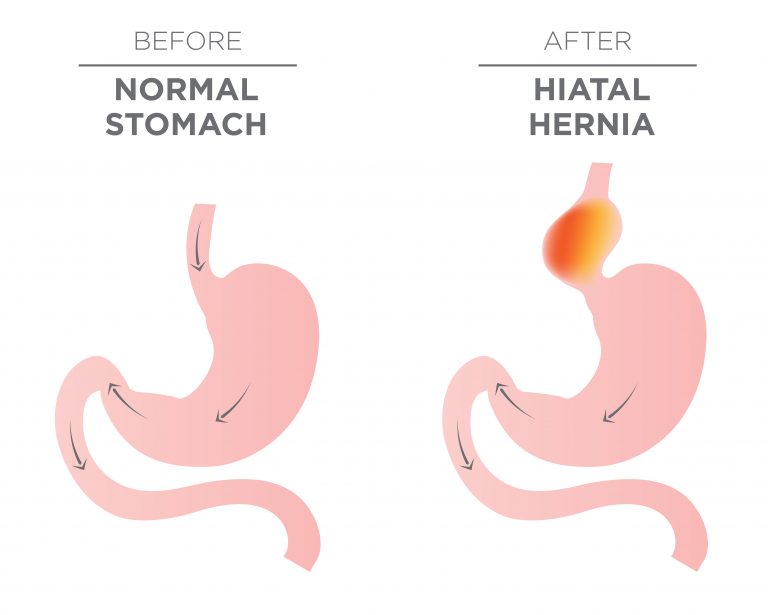 Hiatal Hernia Symptoms And Treatment In North Texas Dallas Fort Worth