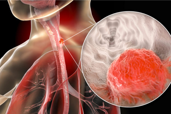 Esophageal cancer showing malignant tumor in the human esophagus