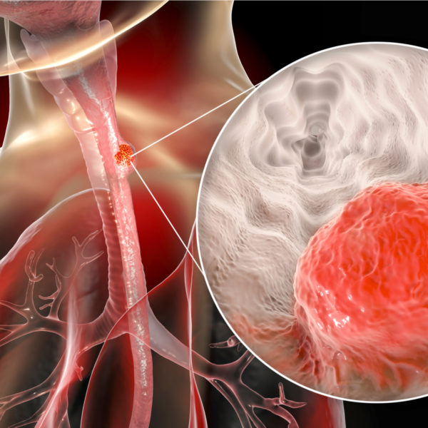 Esophageal cancer showing malignant tumor in the human esophagus