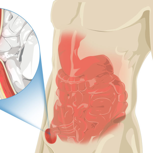 Human Illustration with Stomach Pain, Zoom-in inguinal hernia