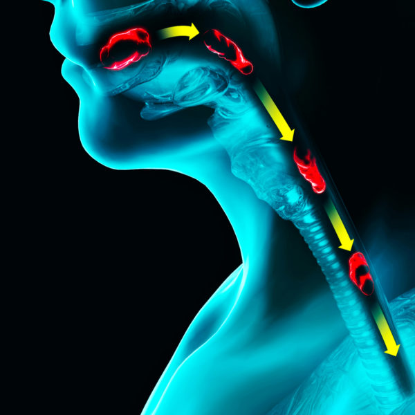 Swallowing Disorders